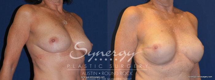 Before & After Reconstruction - Breast Cancer Case 240 View #4 View in Austin, TX