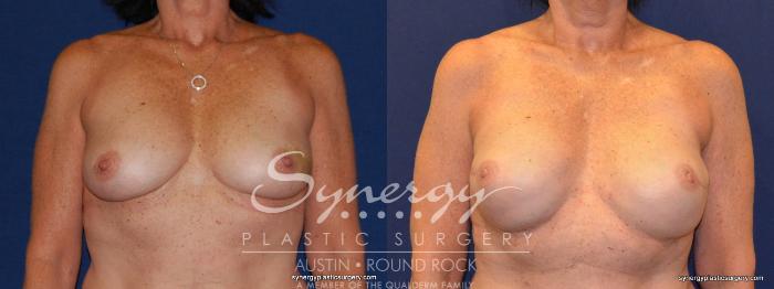 Before & After Reconstruction - Breast Cancer Case 240 View #5 View in Austin, TX