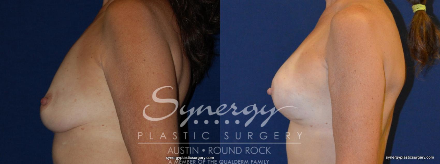 Before & After Reconstruction - Breast Cancer Case 241 View #1 View in Round Rock, TX
