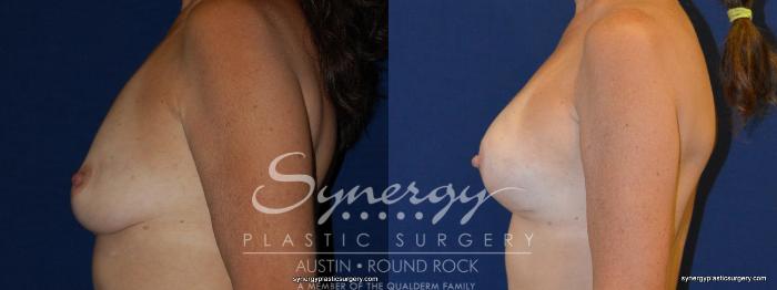 Before & After Reconstruction - Breast Cancer Case 241 View #1 View in Austin, TX