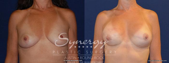 Before & After Reconstruction - Breast Cancer Case 241 View #2 View in Austin, TX