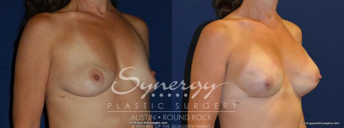 Before & After Reconstruction - Breast Cancer Case 241 View #3 View in Austin, TX
