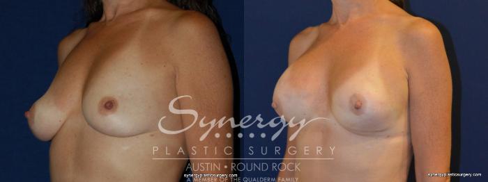 Before & After Reconstruction - Breast Cancer Case 241 View #4 View in Austin, TX