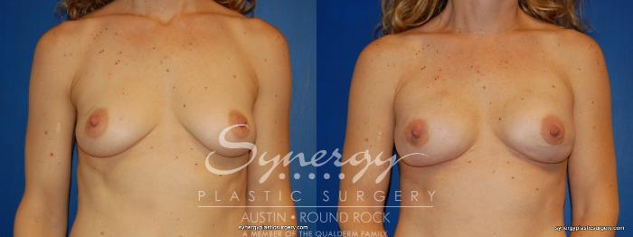 Before & After Reconstruction - Breast Cancer Case 243 View #1 View in Austin, TX