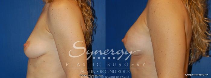 Before & After Reconstruction - Breast Cancer Case 243 View #2 View in Austin, TX