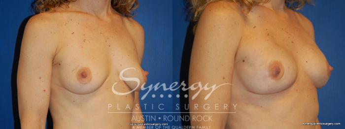 Before & After Reconstruction - Breast Cancer Case 243 View #3 View in Austin, TX