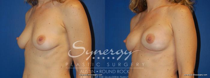 Before & After Reconstruction - Breast Cancer Case 243 View #4 View in Austin, TX