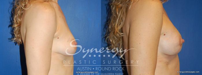 Before & After Reconstruction - Breast Cancer Case 243 View #5 View in Austin, TX
