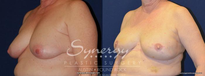 Before & After Reconstruction - Breast Cancer Case 247 View #2 View in Austin, TX