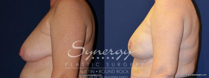 Before & After Reconstruction - Breast Cancer Case 247 View #3 View in Austin, TX