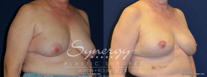 Before & After Reconstruction - Breast Cancer Case 247 View #4 View in Austin, TX