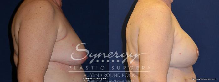 Before & After Reconstruction - Breast Cancer Case 247 View #5 View in Austin, TX