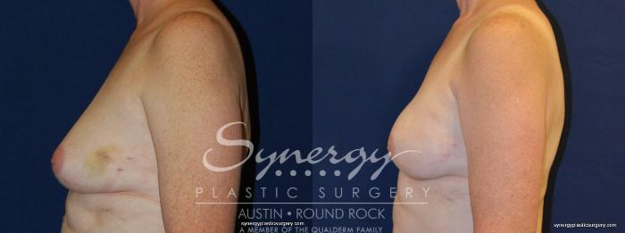 Before & After Reconstruction - Breast Cancer Case 254 View #2 View in Austin, TX