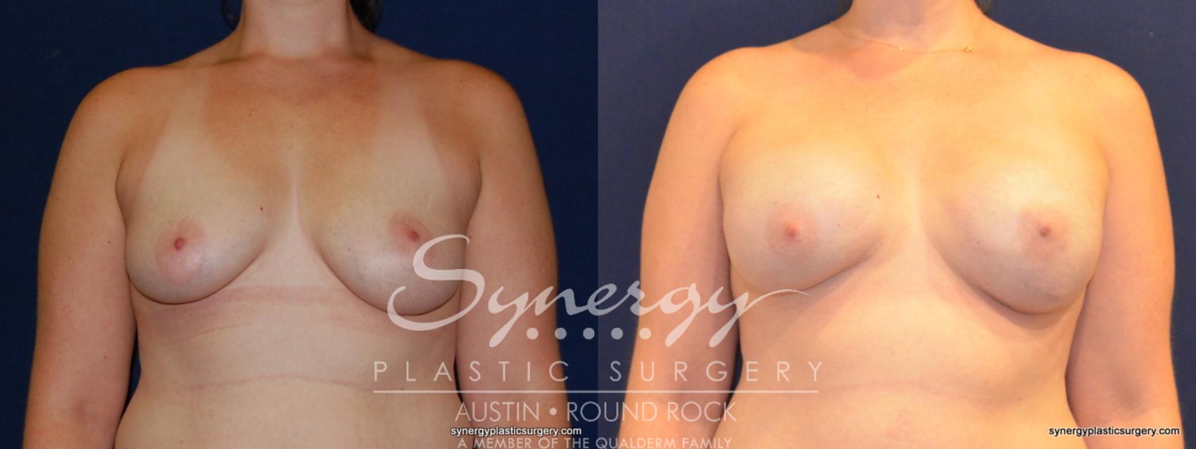 Before & After Reconstruction - Breast Cancer Case 342 View #1 View in Round Rock, TX