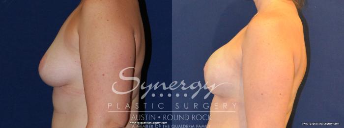 Before & After Reconstruction - Breast Cancer Case 342 View #2 View in Austin, TX