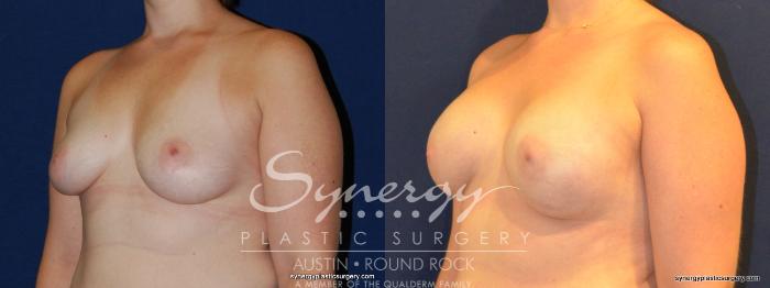 Before & After Reconstruction - Breast Cancer Case 342 View #3 View in Austin, TX