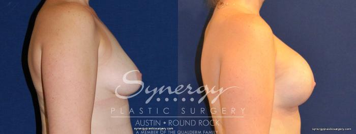 Before & After Reconstruction - Breast Cancer Case 342 View #4 View in Austin, TX