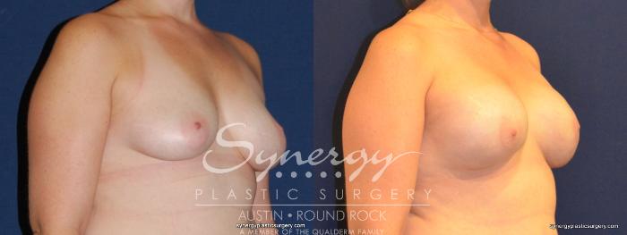 Before & After Reconstruction - Breast Cancer Case 342 View #5 View in Austin, TX