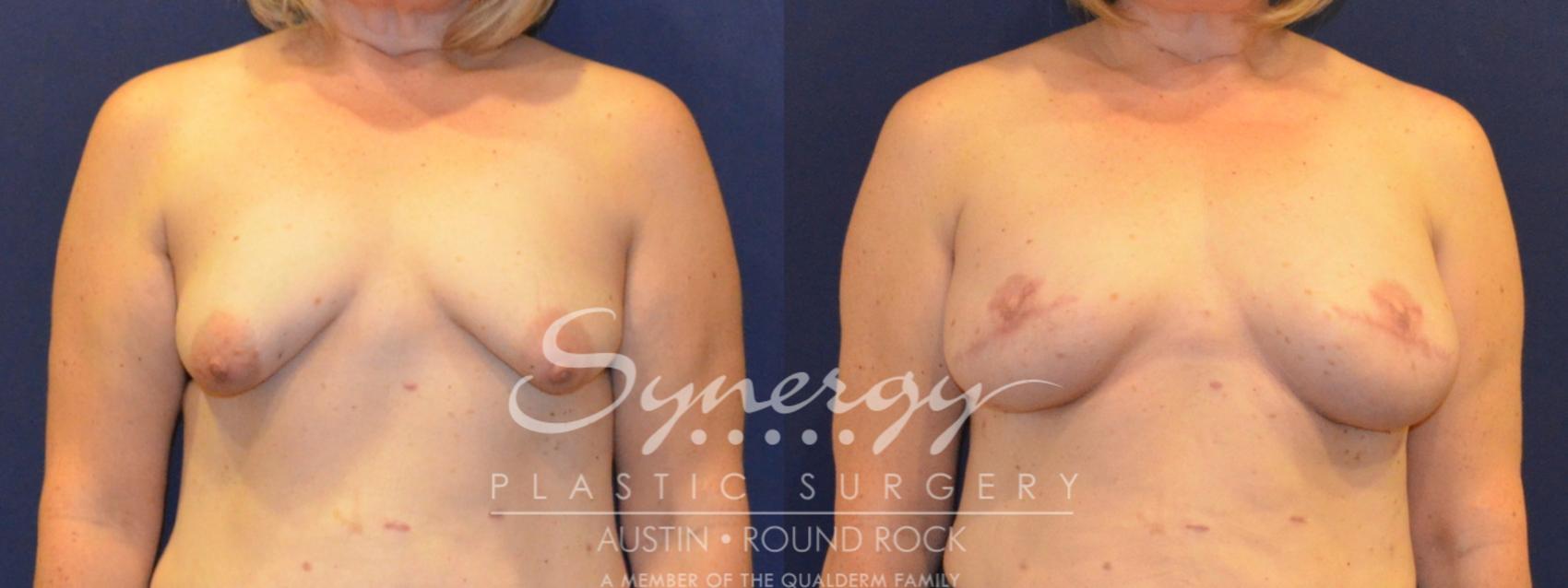 Before & After Reconstruction - Breast Cancer Case 365 View #1 View in Round Rock, TX