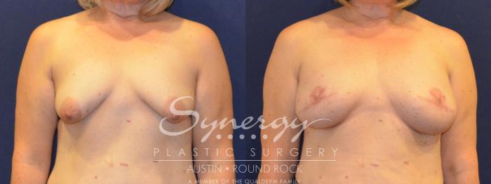 Before & After Reconstruction - Breast Cancer Case 365 View #1 View in Austin, TX