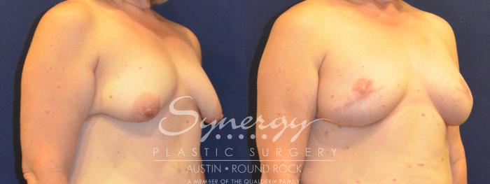 Before & After Reconstruction - Breast Cancer Case 365 View #2 View in Austin, TX