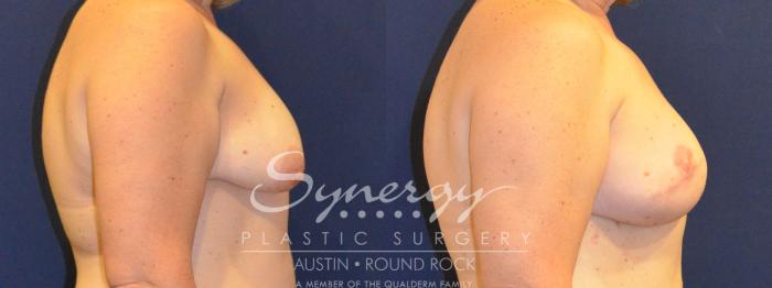Before & After Reconstruction - Breast Cancer Case 365 View #3 View in Austin, TX