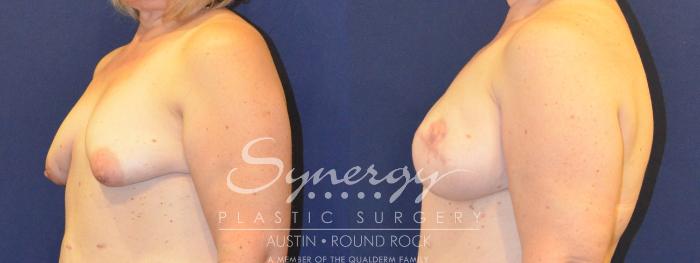 Before & After Reconstruction - Breast Cancer Case 365 View #4 View in Austin, TX