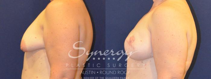 Before & After Reconstruction - Breast Cancer Case 365 View #5 View in Austin, TX