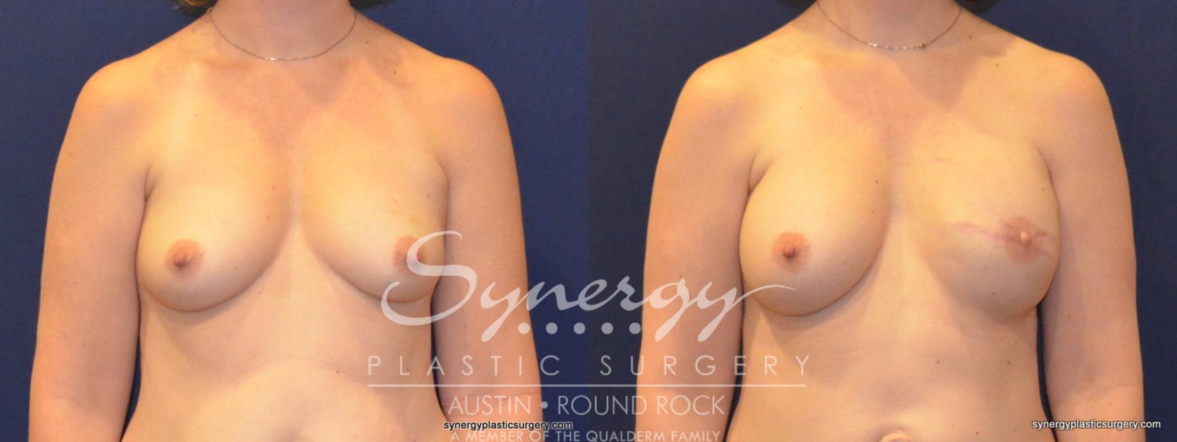 Before & After Reconstruction - Breast Cancer Case 368 View #1 View in Round Rock, TX