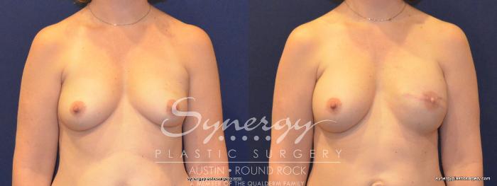Before & After Reconstruction - Breast Cancer Case 368 View #1 View in Austin, TX