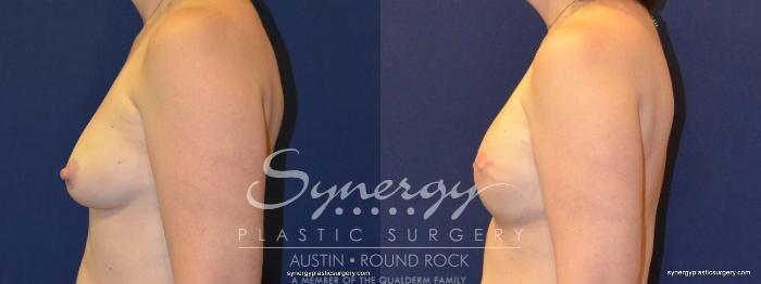 Before & After Reconstruction - Breast Cancer Case 368 View #2 View in Austin, TX