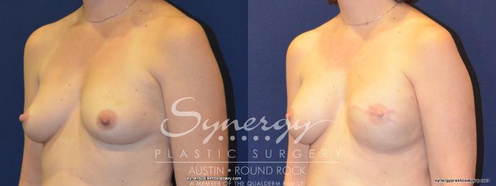 Before & After Reconstruction - Breast Cancer Case 368 View #3 View in Austin, TX