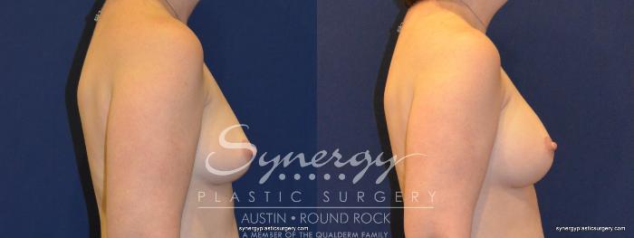 Before & After Reconstruction - Breast Cancer Case 368 View #4 View in Austin, TX