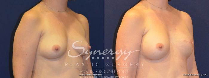 Before & After Reconstruction - Breast Cancer Case 368 View #5 View in Austin, TX