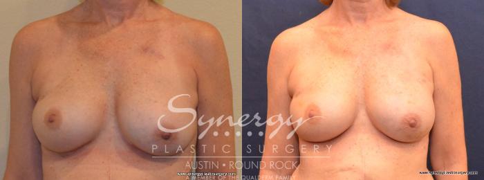 Before & After Reconstruction - Breast Cancer Case 404 View #1 View in Austin, TX