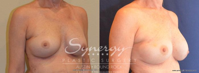 Before & After Reconstruction - Breast Cancer Case 404 View #2 View in Austin, TX