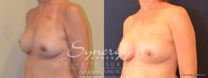 Before & After Reconstruction - Breast Cancer Case 404 View #3 View in Austin, TX