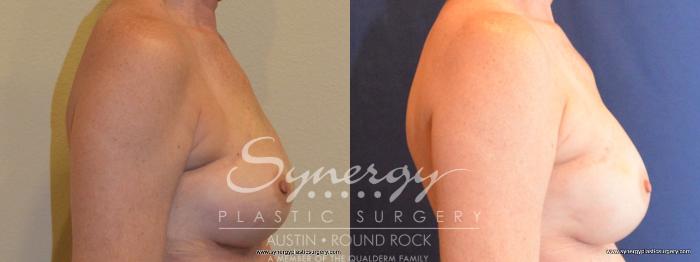 Before & After Reconstruction - Breast Cancer Case 404 View #4 View in Austin, TX