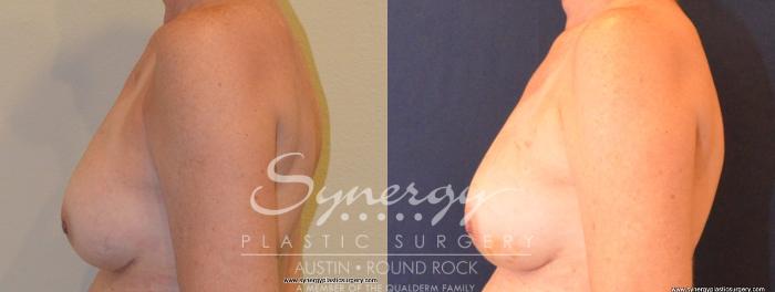 Before & After Reconstruction - Breast Cancer Case 404 View #5 View in Austin, TX