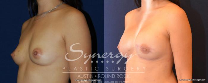 Before & After Reconstruction - Breast Cancer Case 540 View #2 View in Austin, TX