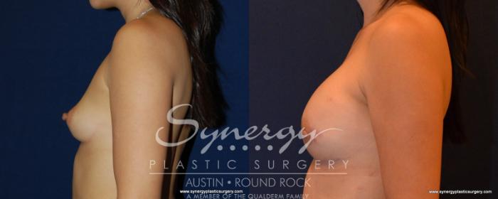 Before & After Reconstruction - Breast Cancer Case 540 View #3 View in Austin, TX