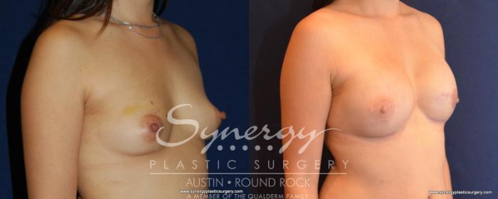 Before & After Reconstruction - Breast Cancer Case 540 View #4 View in Austin, TX