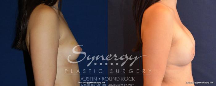 Before & After Reconstruction - Breast Cancer Case 540 View #5 View in Austin, TX