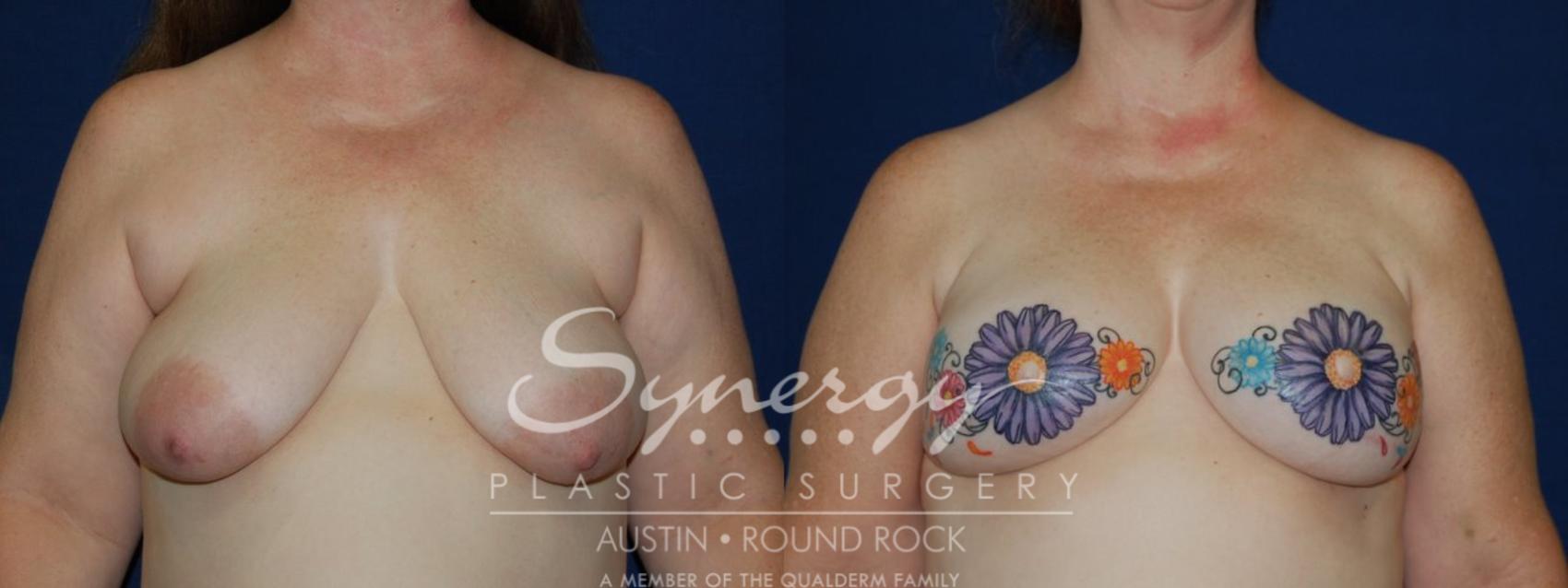 Before & After Reconstruction - Breast Cancer Case 97 View #1 View in Round Rock, TX