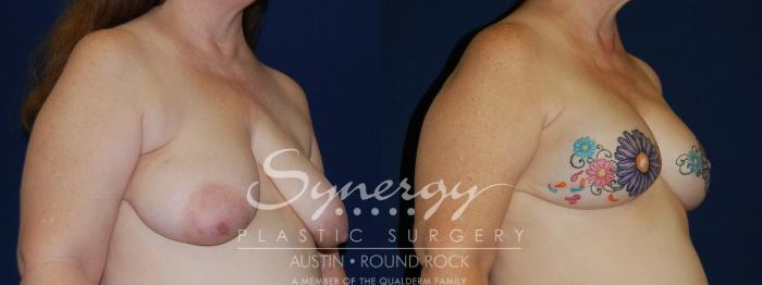 Before & After Reconstruction - Breast Cancer Case 97 View #2 View in Austin, TX