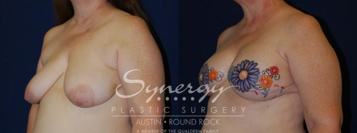 Before & After Reconstruction - Breast Cancer Case 97 View #3 View in Austin, TX