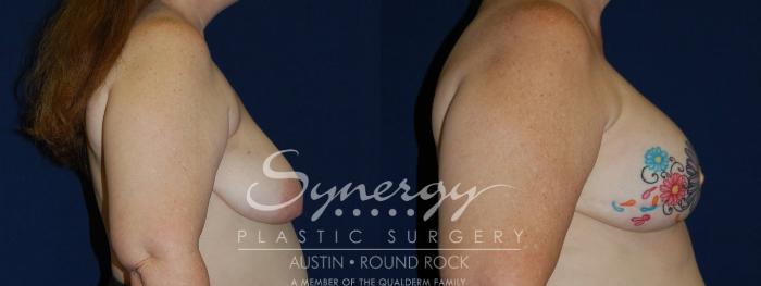 Before & After Reconstruction - Breast Cancer Case 97 View #4 View in Austin, TX