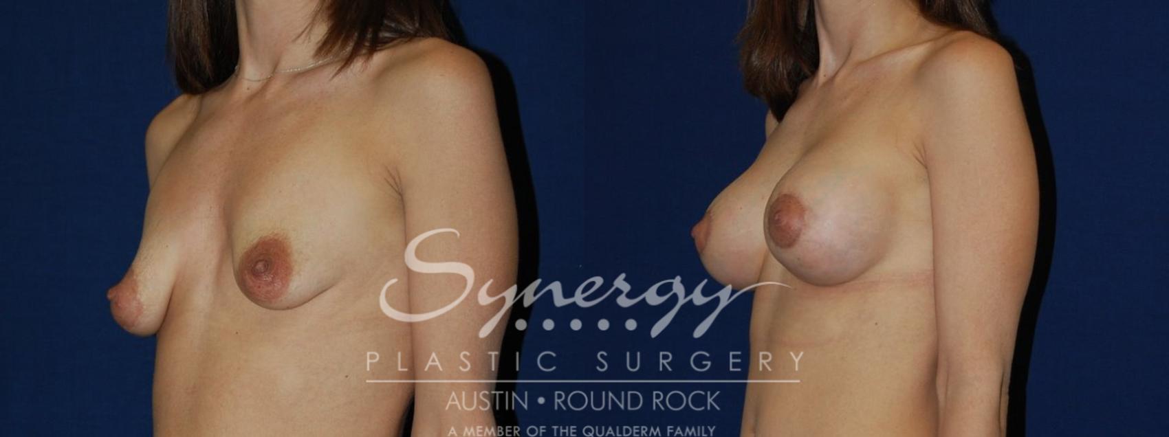 Before & After Reconstruction - Congenital Breast Case 134 View #1 View in Round Rock, TX