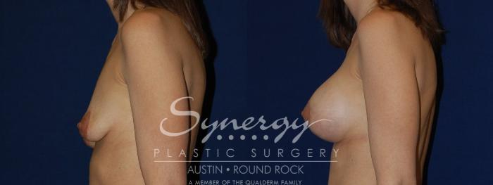Before & After Reconstruction - Congenital Breast Case 134 View #4 View in Austin, TX