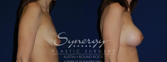 Before & After Reconstruction - Congenital Breast Case 134 View #5 View in Austin, TX